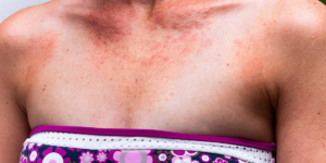 Allergy to the sun, how to protect yourself