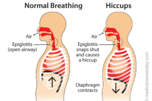 get rid of hiccups