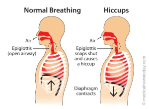 get rid of hiccups