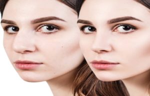 An Insight into Revision Rhinoplasty Surgeries