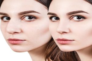 An Insight into Revision Rhinoplasty Surgeries